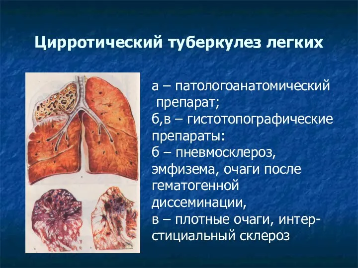 Цирротический туберкулез легких а – патологоанатомический препарат; б,в – гистотопографические препараты: б