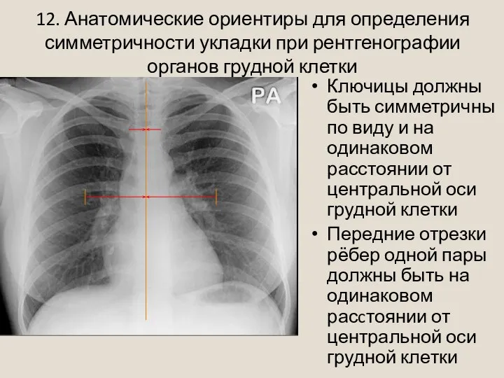 12. Анатомические ориентиры для определения симметричности укладки при рентгенографии органов грудной клетки