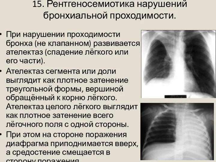 15. Рентгеносемиотика нарушений бронхиальной проходимости. При нарушении проходимости бронха (не клапанном) развивается