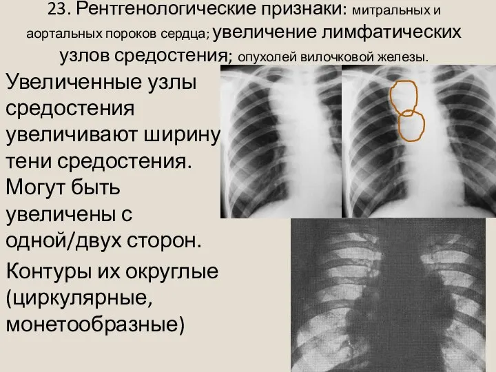 23. Рентгенологические признаки: митральных и аортальных пороков сердца; увеличение лимфатических узлов средостения;