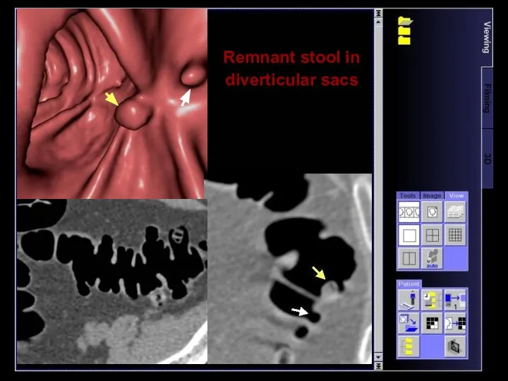 Remnant stool in diverticular sacs