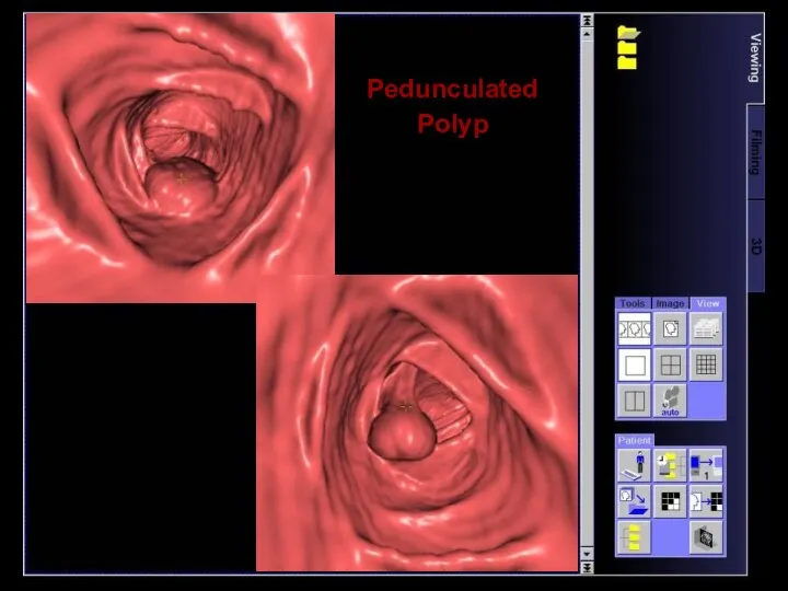 Pedunculated Polyp