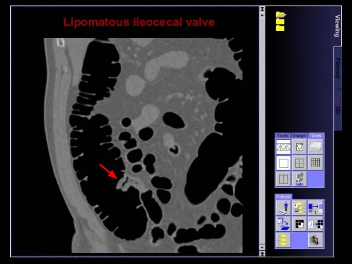 Lipomatous ileocecal valve