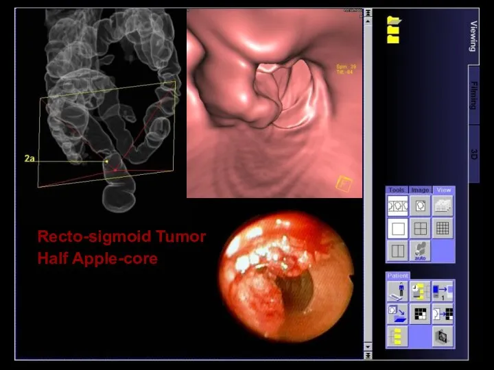 Recto-sigmoid Tumor Half Apple-core