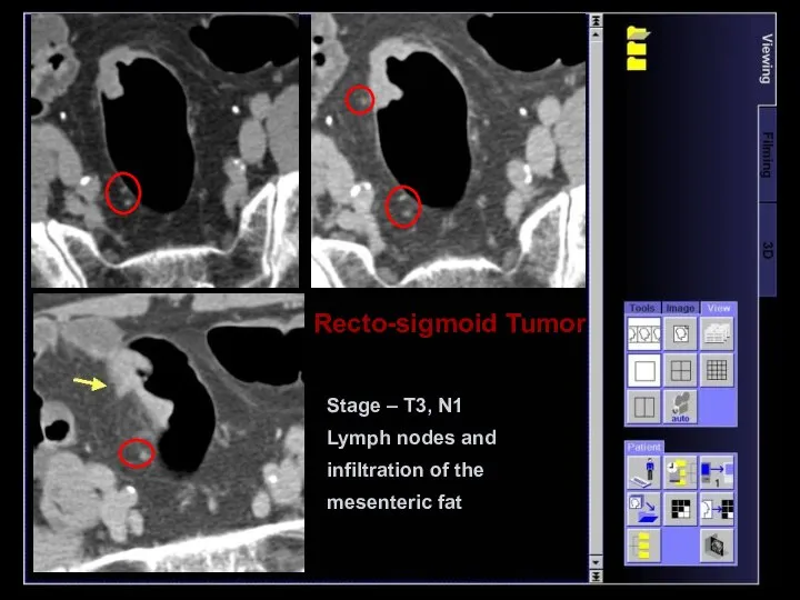 Recto-sigmoid Tumor Stage – T3, N1 Lymph nodes and infiltration of the mesenteric fat