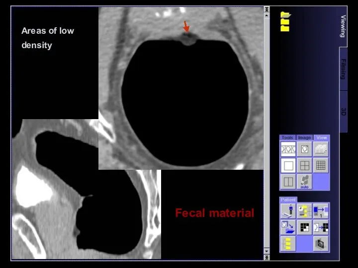 Areas of low density Fecal material