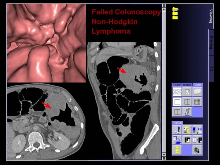 Failed Colonoscopy Non-Hodgkin Lymphoma