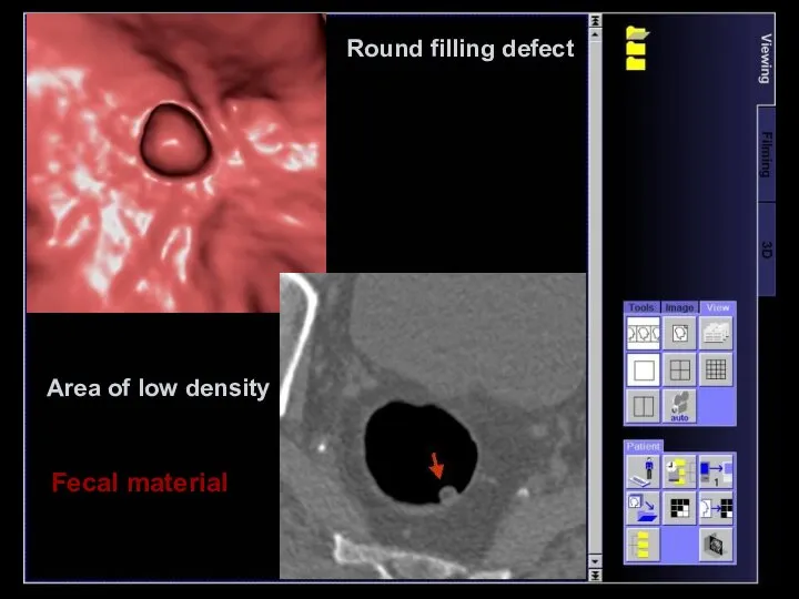 Round filling defect Fecal material