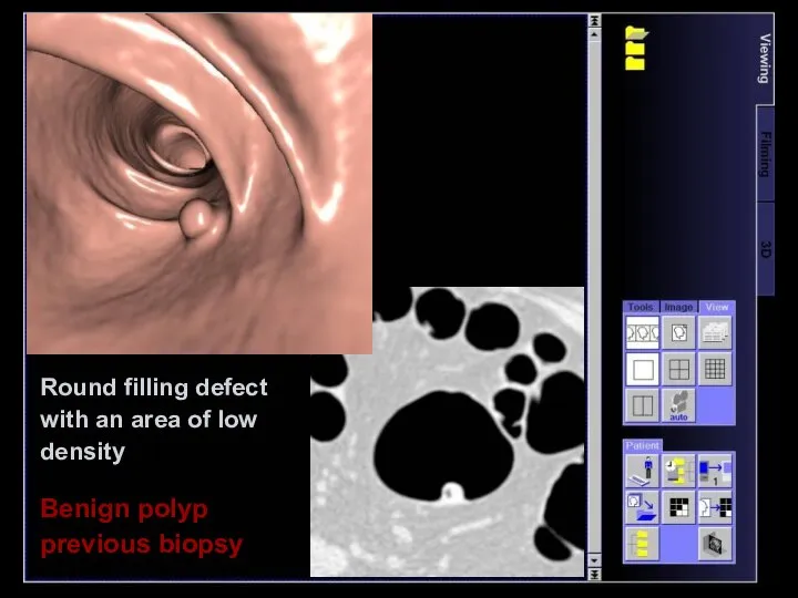 Round filling defect with an area of low density Benign polyp previous biopsy