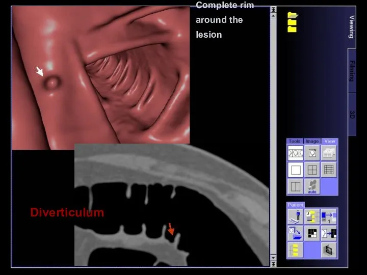 Complete rim around the lesion