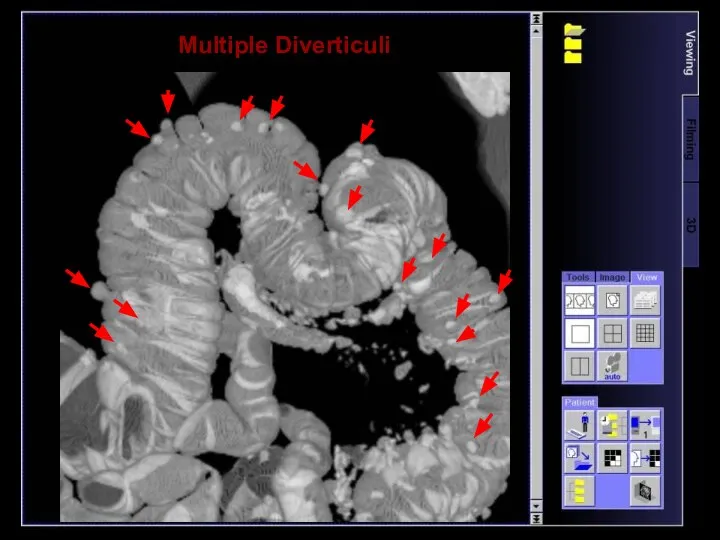 Multiple Diverticuli