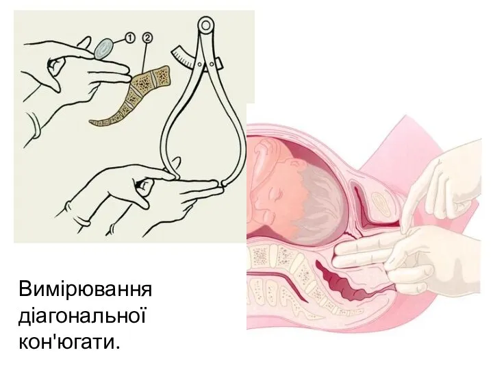 Вимірювання діагональної кон'югати.