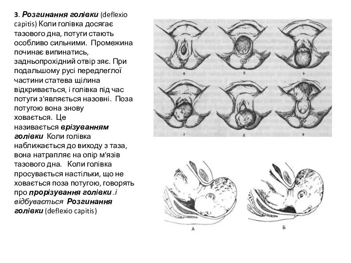 3. Розгинання голiвки (deflexio capitis) Коли голiвка досягає тазового дна, потуги стають