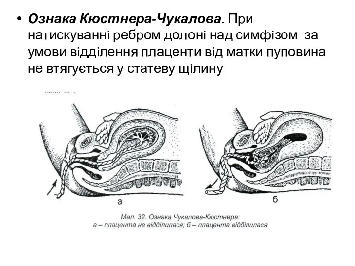 Ознака Кюстнера-Чукалова. При натискуваннi ребром долонi над симфiзом за умови вiддiлення плаценти