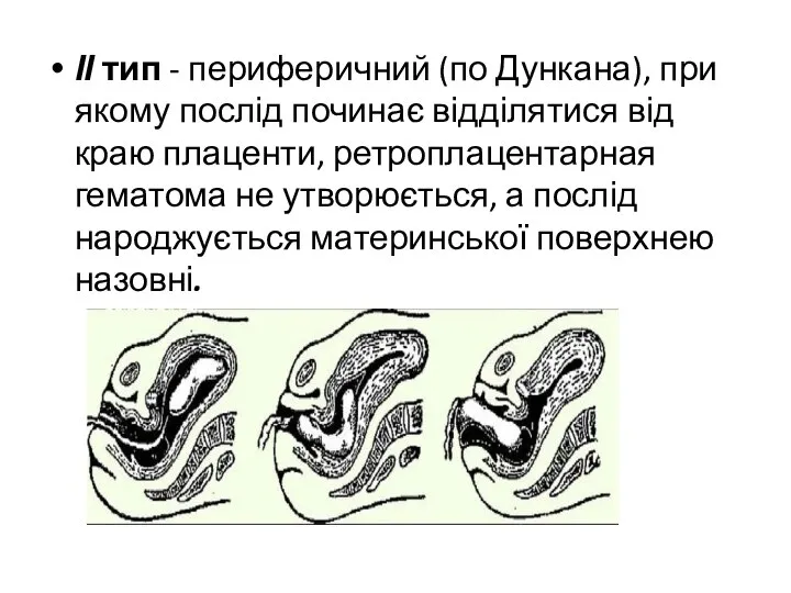 ІІ тип - периферичний (по Дункана), при якому послід починає відділятися від