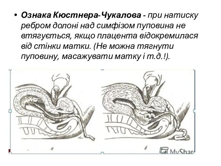 Ознака Кюстнера-Чукалова - при натиску ребром долоні над симфізом пуповина не втягується,