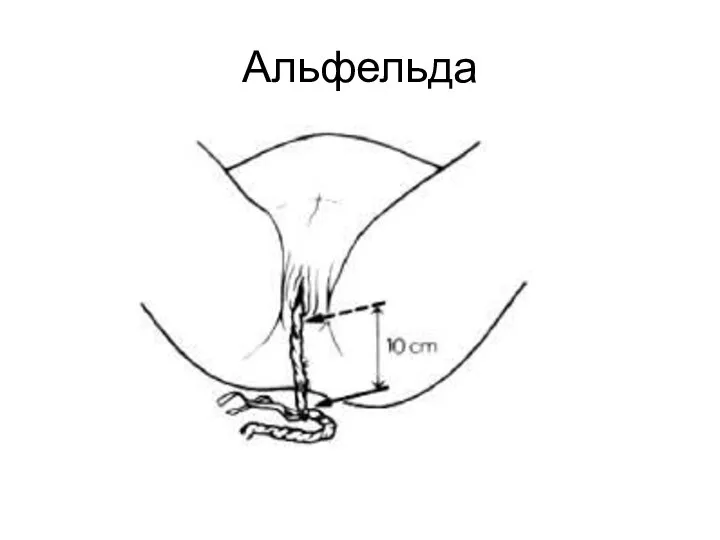 Альфельда