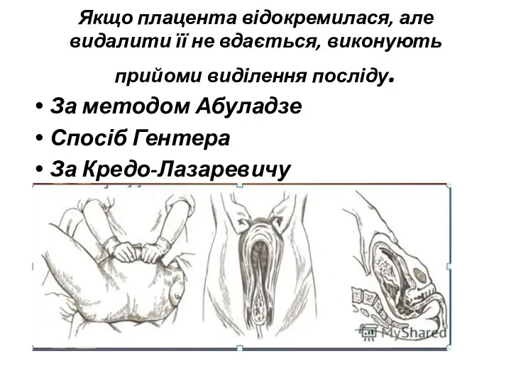 Якщо плацента відокремилася, але видалити її не вдається, виконують прийоми виділення посліду.