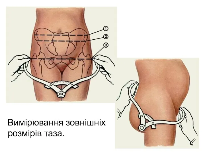 Вимірювання зовнішніх розмірів таза.