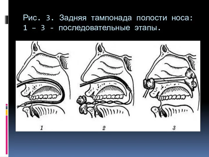 Рис. 3. Задняя тампонада полости носа: 1 – 3 - последовательные этапы.