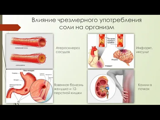 Влияние чрезмерного употребления соли на организм Атеросклероз сосудов Язвенная болезнь желудка и