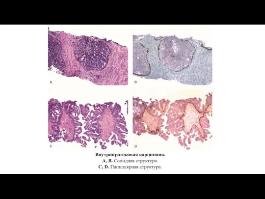 Внутрипротоковая карцинома. А, В. Солидная структура. С, D. Папиллярная структура.