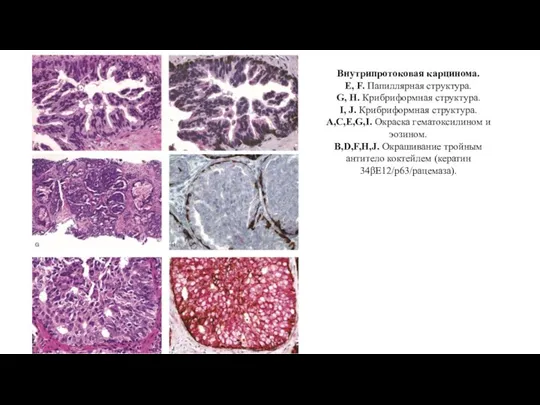 Внутрипротоковая карцинома. E, F. Папиллярная структура. G, H. Крибриформная структура. I, J.
