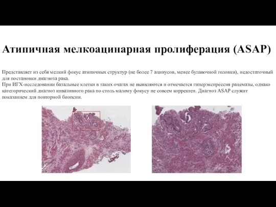 Атипичная мелкоацинарная пролиферация (ASAP) Представляет из себя мелкий фокус атипичных структур (не