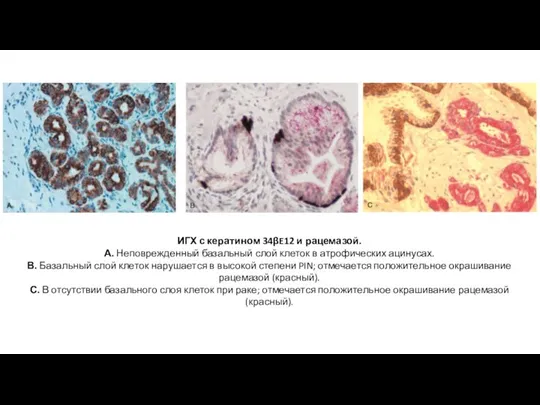 ИГХ с кератином 34βE12 и рацемазой. А. Неповрежденный базальный слой клеток в