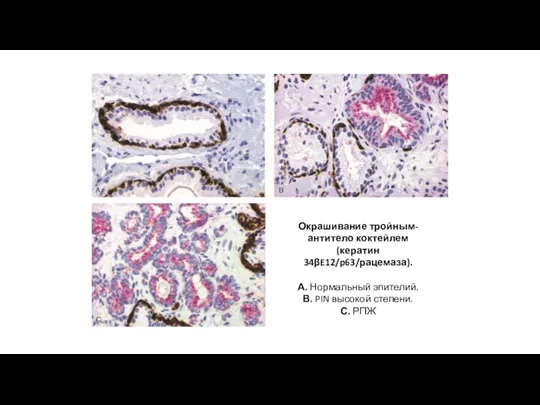 Окрашивание тройным-антитело коктейлем (кератин 34βE12/p63/рацемаза). А. Нормальный эпителий. В. PIN высокой степени. С. РПЖ