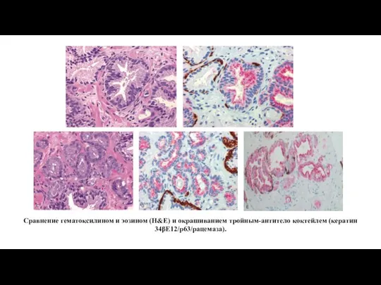 Сравнение гематоксилином и эозином (H&Е) и окрашиванием тройным-антитело коктейлем (кератин 34βE12/p63/рацемаза).