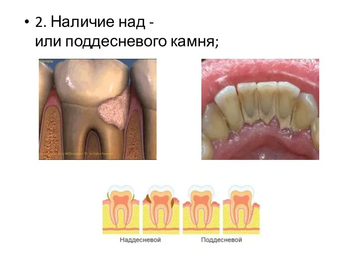 2. Наличие над - или поддесневого камня;