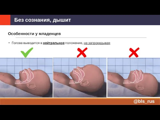 Особенности у младенцев Голова выводится в нейтральное положение, не запрокидывая Без сознания, дышит @bls_rus