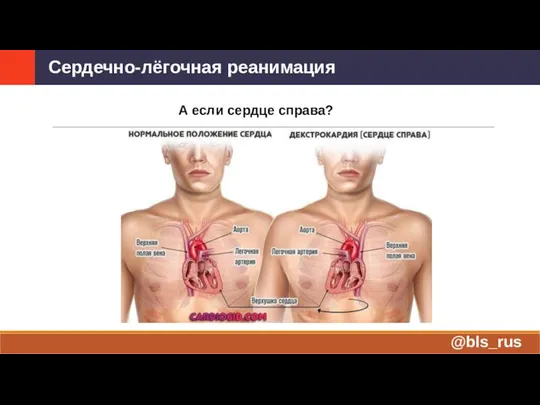 А если сердце справа? Сердечно-лёгочная реанимация @bls_rus