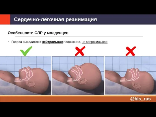 Особенности СЛР у младенцев Голова выводится в нейтральное положение, не запрокидывая Сердечно-лёгочная реанимация @bls_rus