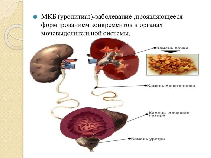 МКБ (уролитиаз)-заболевание ,проявляющееся формированием конкрементов в органах мочевыделительной системы.