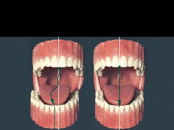Анкилоз Стойкое сведение челюстей, вызванное срастанием поверхности головки нижней челюсти с суставной впадиной височной кости.