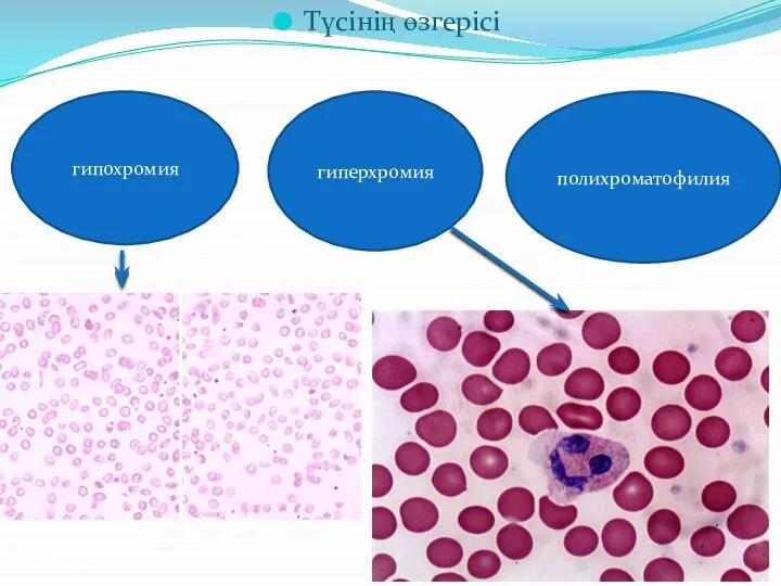 Түсінің өзгерісі гипохромия гиперхромия полихроматофилия