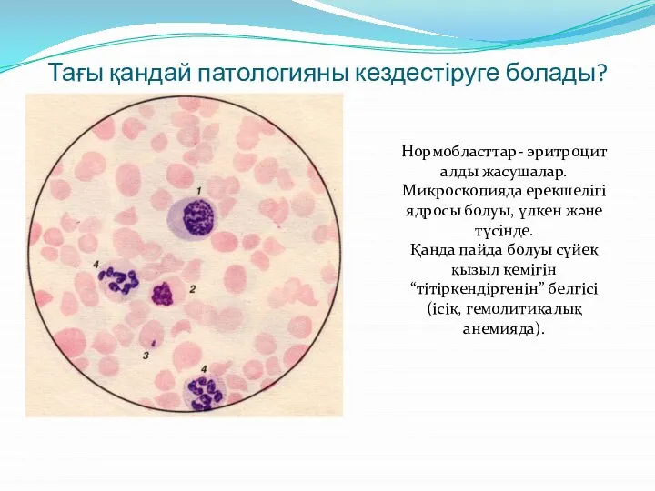 Тағы қандай патологияны кездестіруге болады? Нормобласттар- эритроцит алды жасушалар. Микроскопияда ерекшелігі ядросы