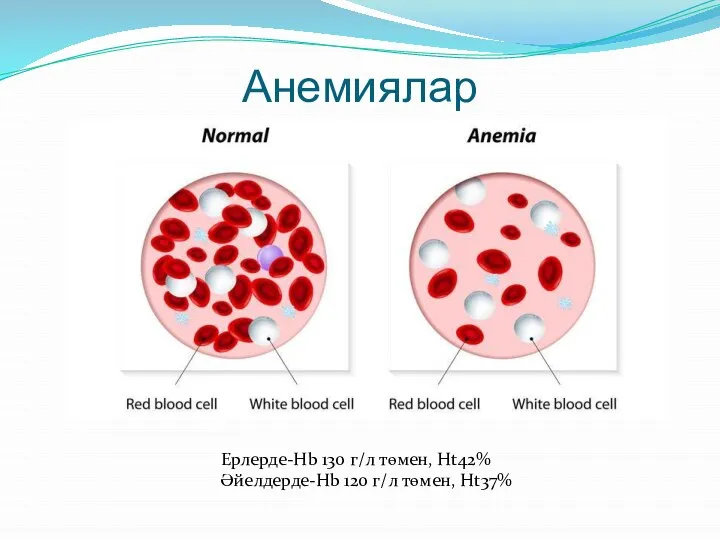 Анемиялар Ерлерде-Hb 130 г/л төмен, Ht42% Әйелдерде-Hb 120 г/л төмен, Ht37%