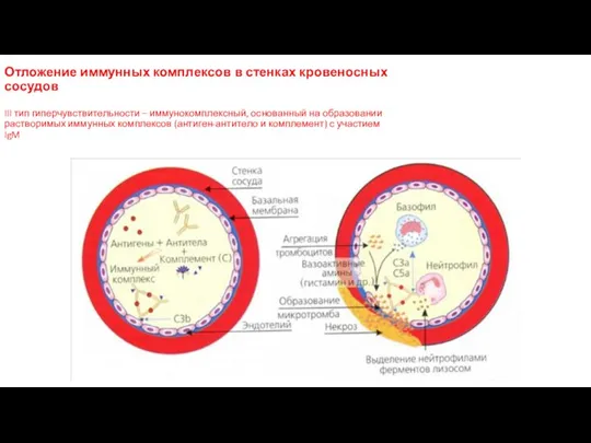Отложение иммунных комплексов в стенках кровеносных сосудов III тип гиперчувствительности – иммунокомплексный,
