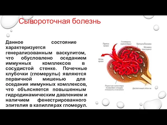 Сывороточная болезнь Данное состояние характеризуется генерализованным васкулитом, что обусловлено оседанием иммунных комплексов