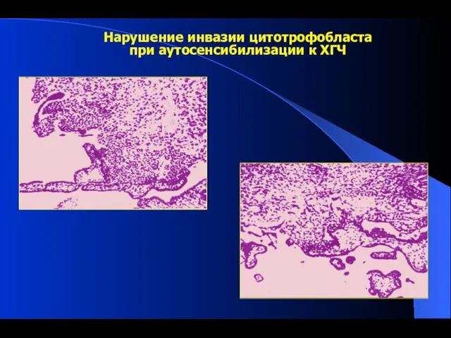 Нарушение инвазии цитотрофобласта при аутосенсибилизации к ХГЧ
