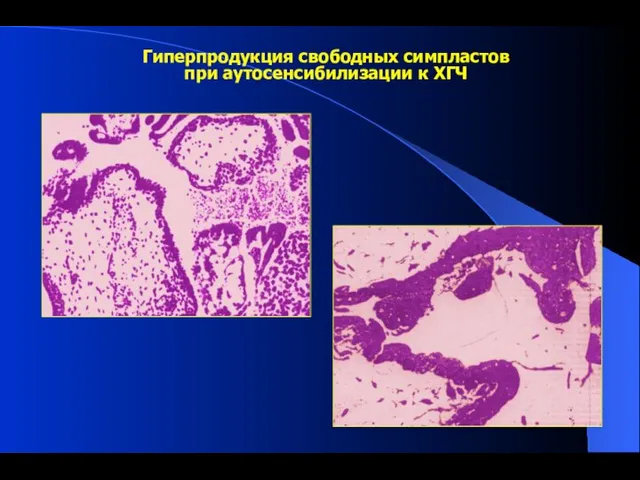 Гиперпродукция свободных симпластов при аутосенсибилизации к ХГЧ
