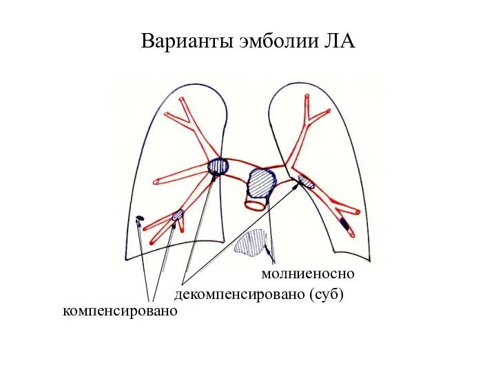 Варианты эмболии ЛА компенсировано декомпенсировано (суб) молниеносно