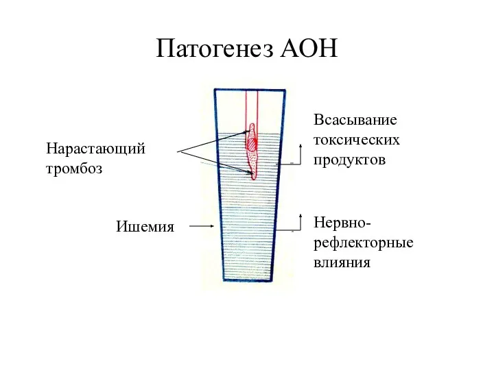 Патогенез АОН Всасывание токсических продуктов Нервно-рефлекторные влияния Нарастающий тромбоз Ишемия