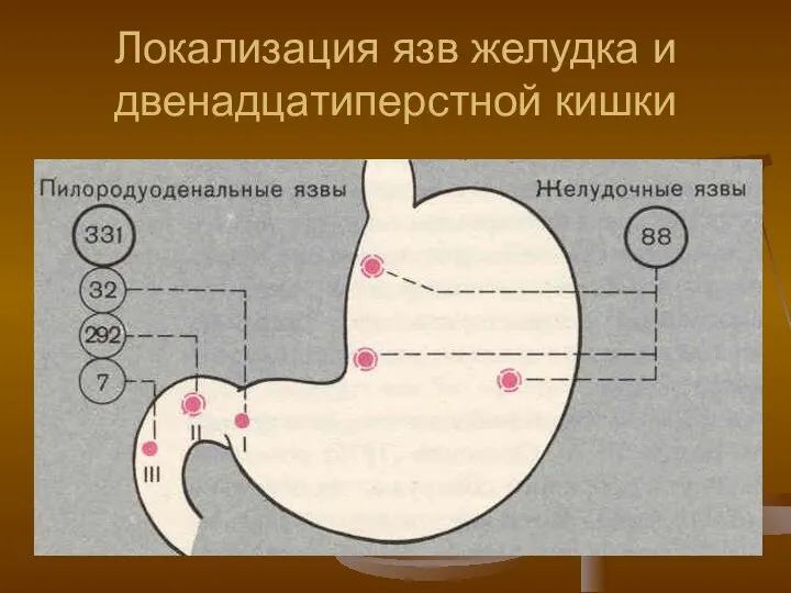 Локализация язв желудка и двенадцатиперстной кишки