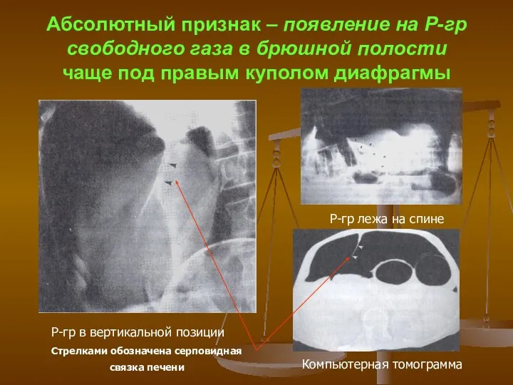 Абсолютный признак – появление на Р-гр свободного газа в брюшной полости чаще