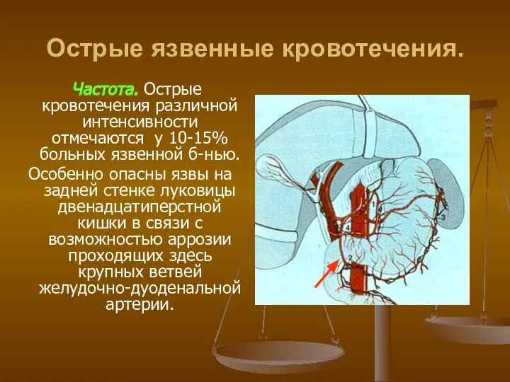 Острые язвенные кровотечения. Частота. Острые кровотечения различной интенсивности отмечаются у 10-15% больных