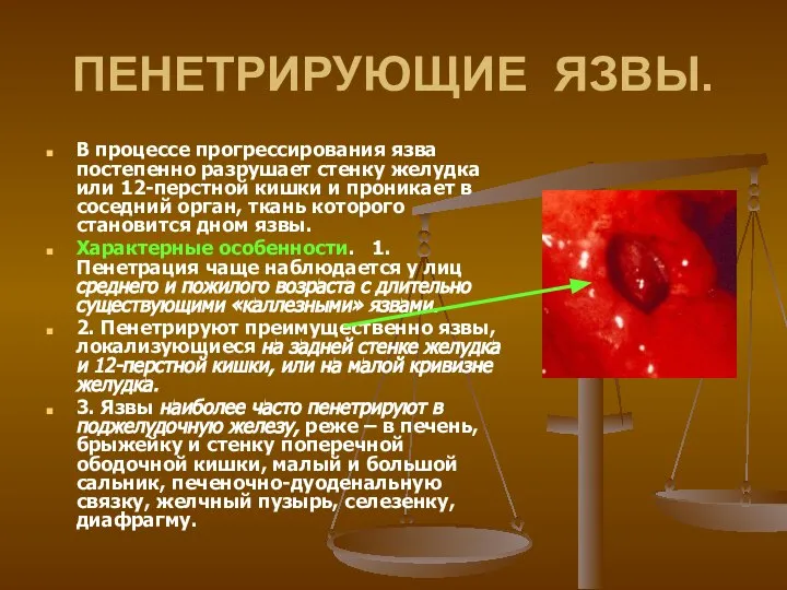 ПЕНЕТРИРУЮЩИЕ ЯЗВЫ. В процессе прогрессирования язва постепенно разрушает стенку желудка или 12-перстной